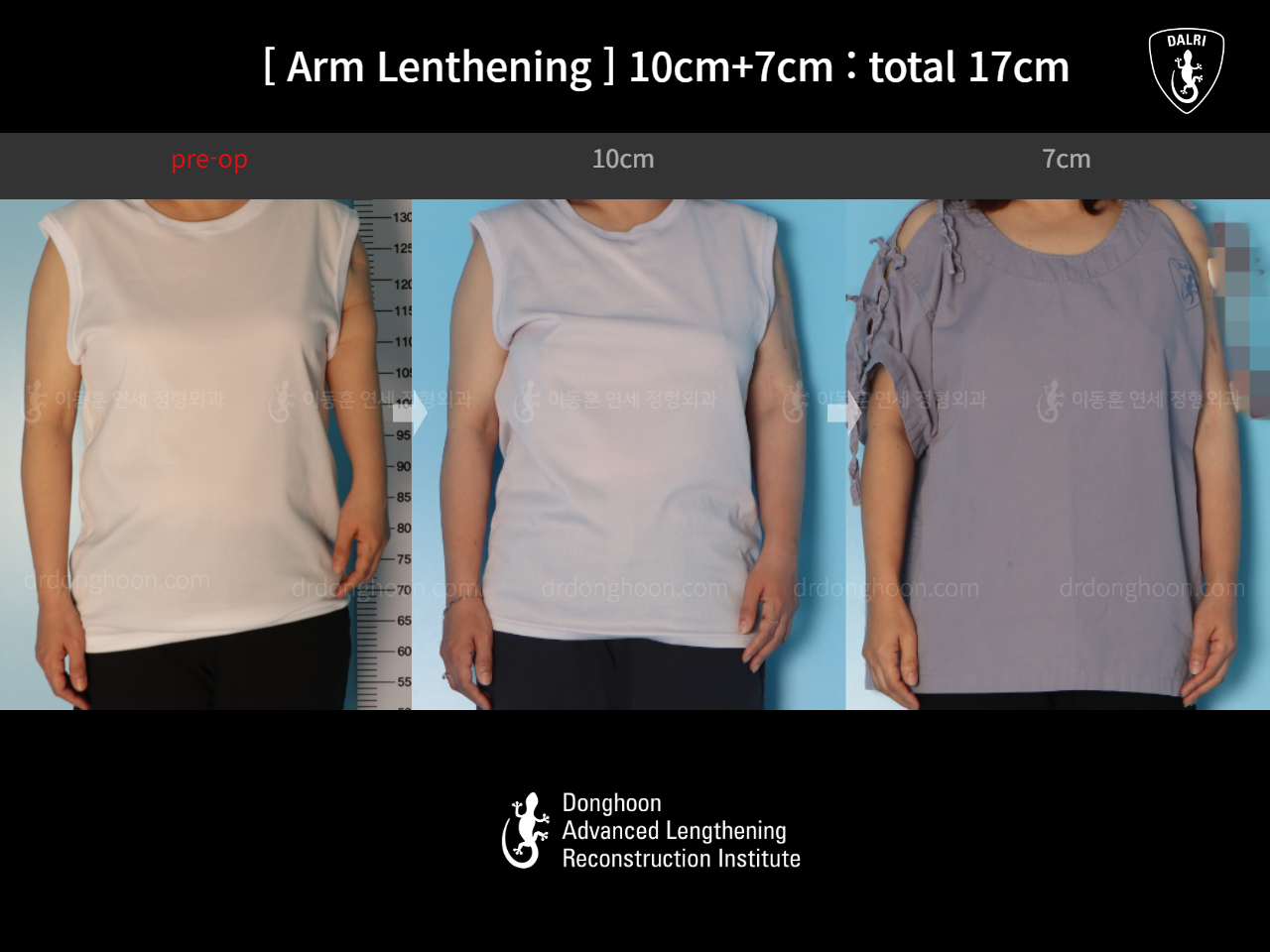 Before and after arm lengthening, case 17457909, image 1, Dr. Donghoon institute (DALRI)