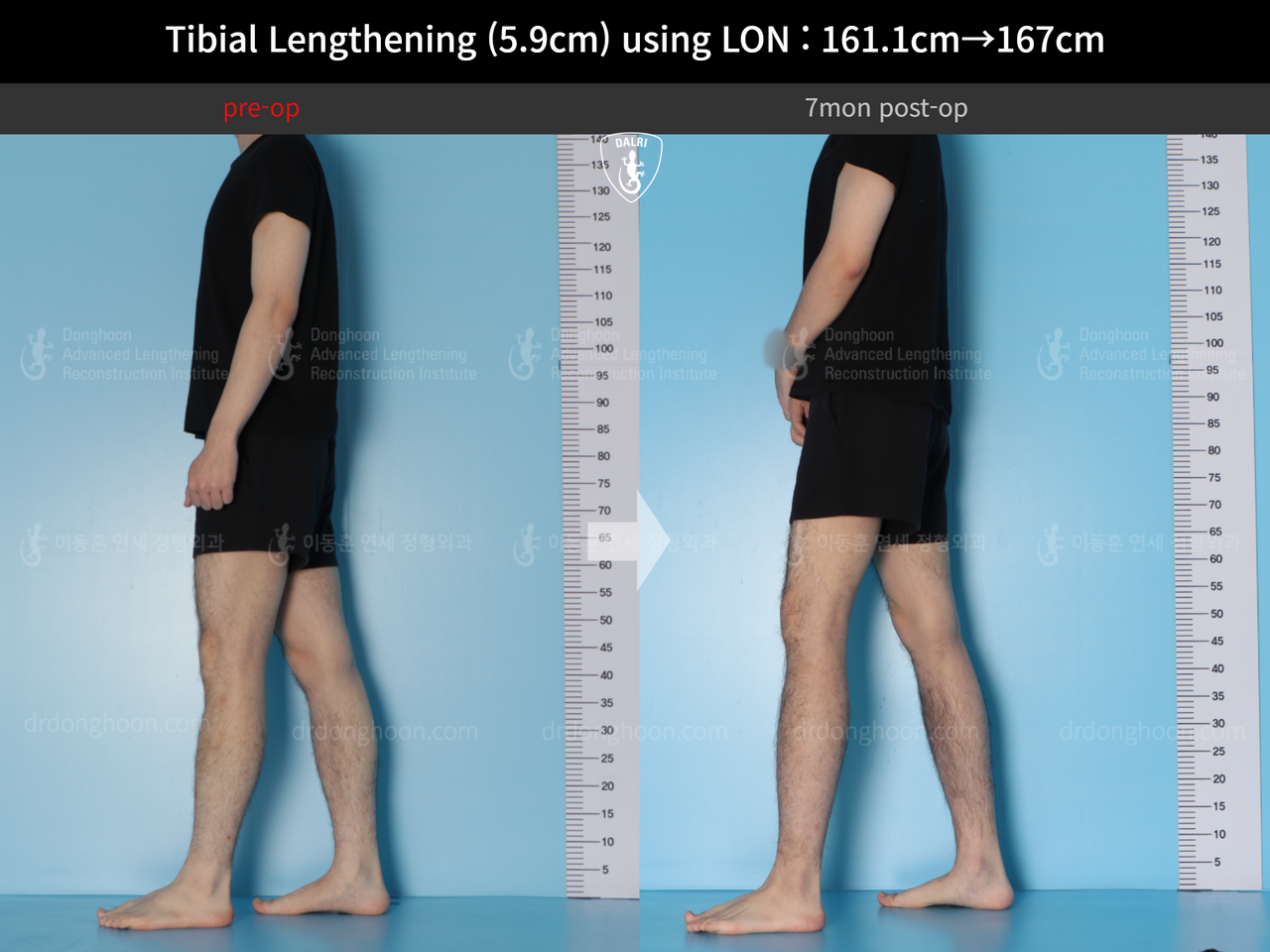 Before and after cll lon, case 14064750, image 5, Dr. Donghoon institute (DALRI)
