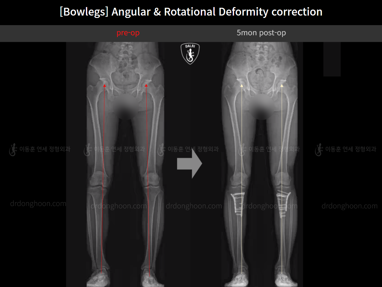 Before and after adult bowlegs, case 14707617, image 10, Dr. Donghoon institute (DALRI)