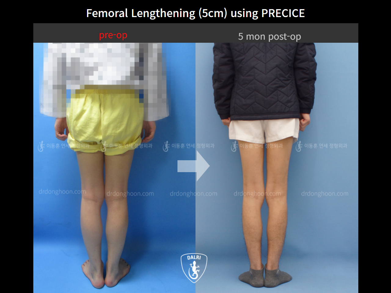 Before and after cll precice, case 9231745, image 3, Dr. Donghoon institute (DALRI)