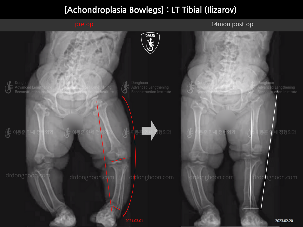 Before and after congenital condition, case 14296141, image 8, Dr. Donghoon institute (DALRI)