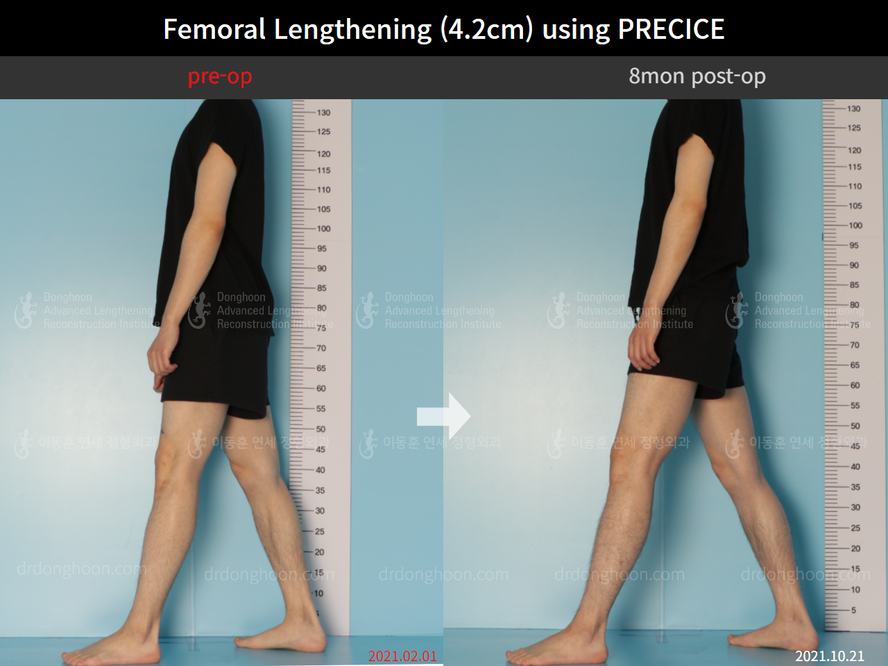 Before and after cll precice, case 8781700, image 4, Dr. Donghoon institute (DALRI)