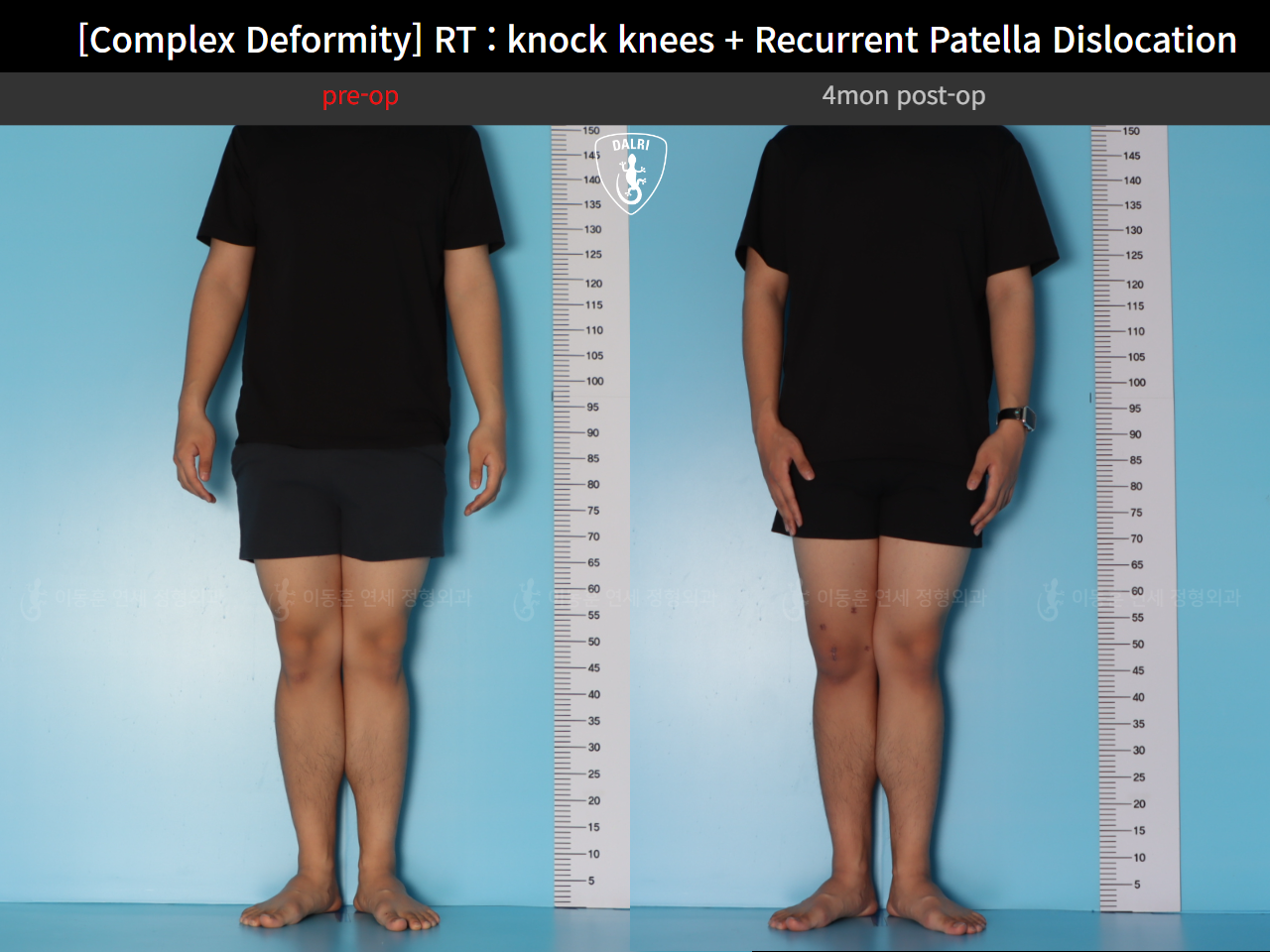 Before and after adult knock knees, case 125841800, image 2, Dr. Donghoon institute (DALRI)