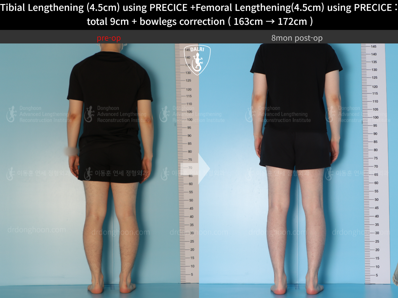 Before and after cll precice, case 13912585, image 4, Dr. Donghoon institute (DALRI)