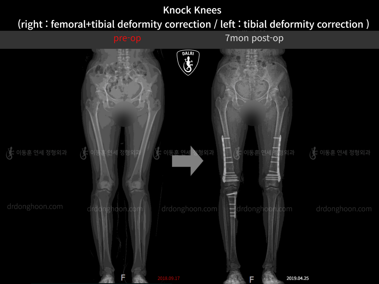 Before and after adult knock knees, case 13229486, image 2, Dr. Donghoon institute (DALRI)