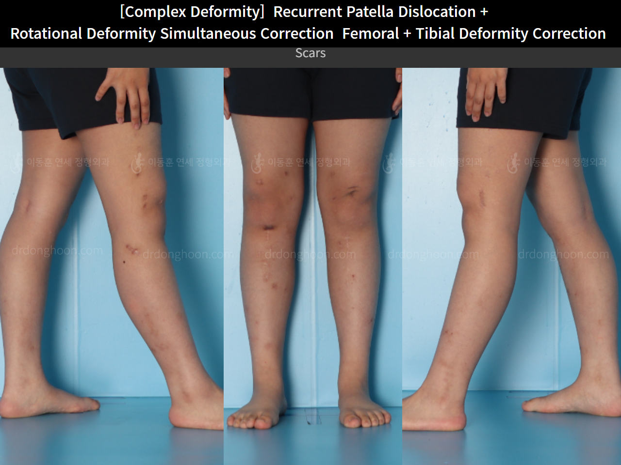 Before and after complex deformity, case 16298867, image 7, Dr. Donghoon institute (DALRI)