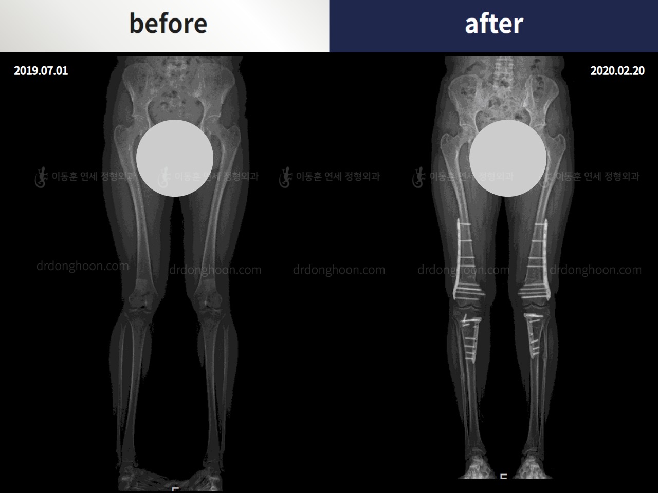Before and after adult knock knees, case 4310881, image 3, Dr. Donghoon institute (DALRI)