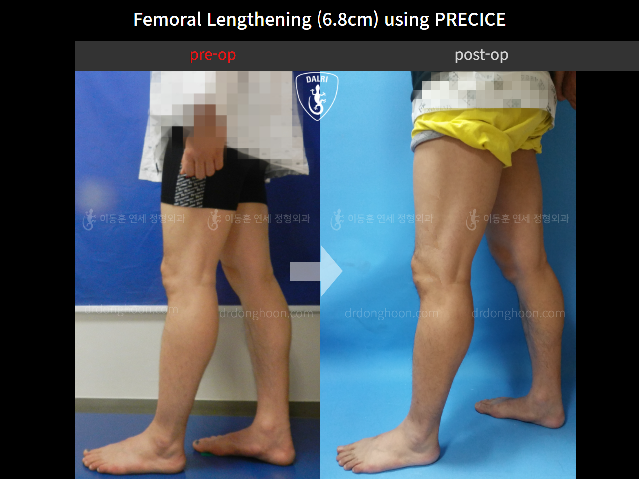 Before and after cll precice, case 4323358, image 3, Dr. Donghoon institute (DALRI)
