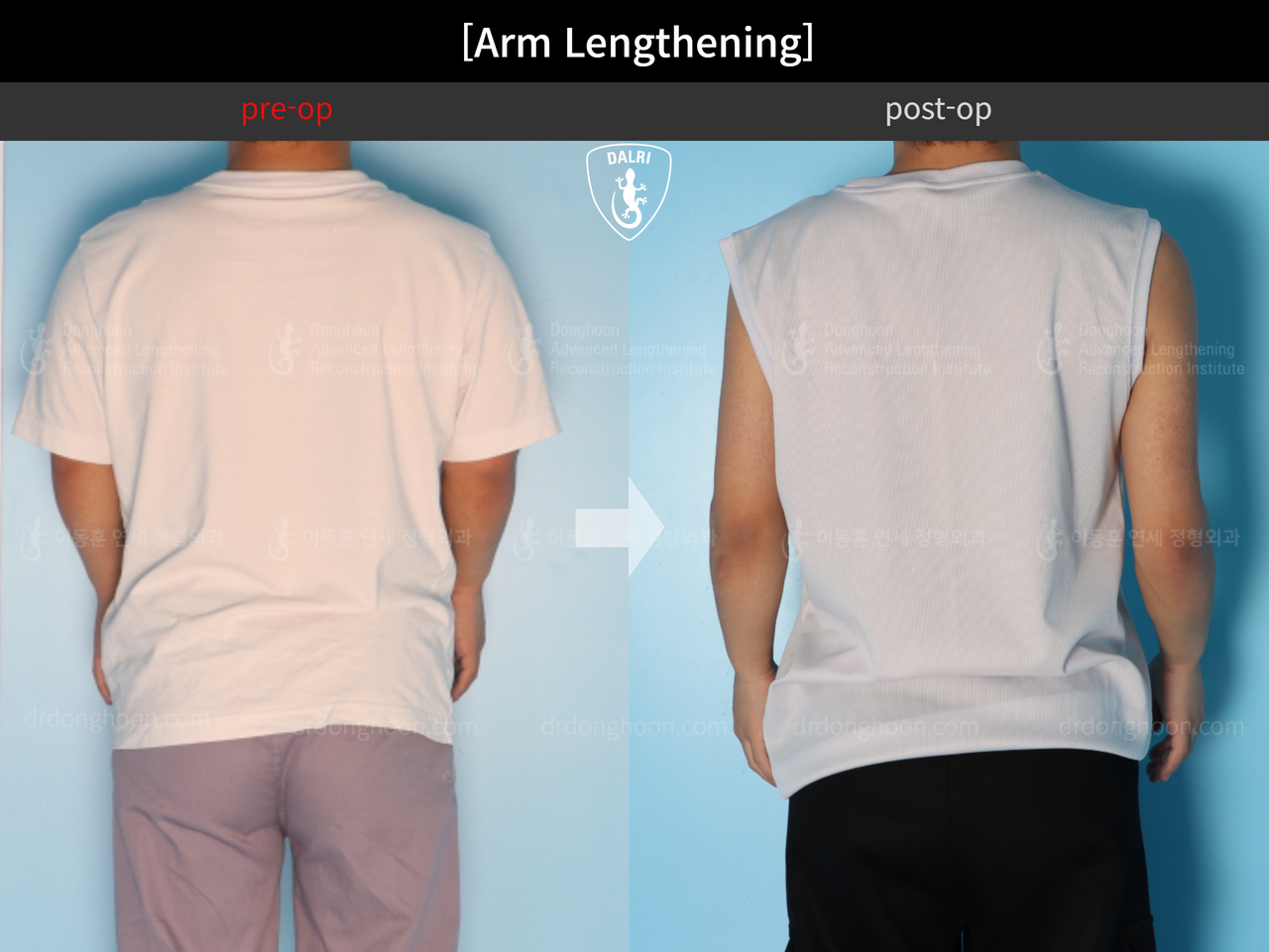 Before and after arm lengthening, case 13957846, image 3, Dr. Donghoon institute (DALRI)