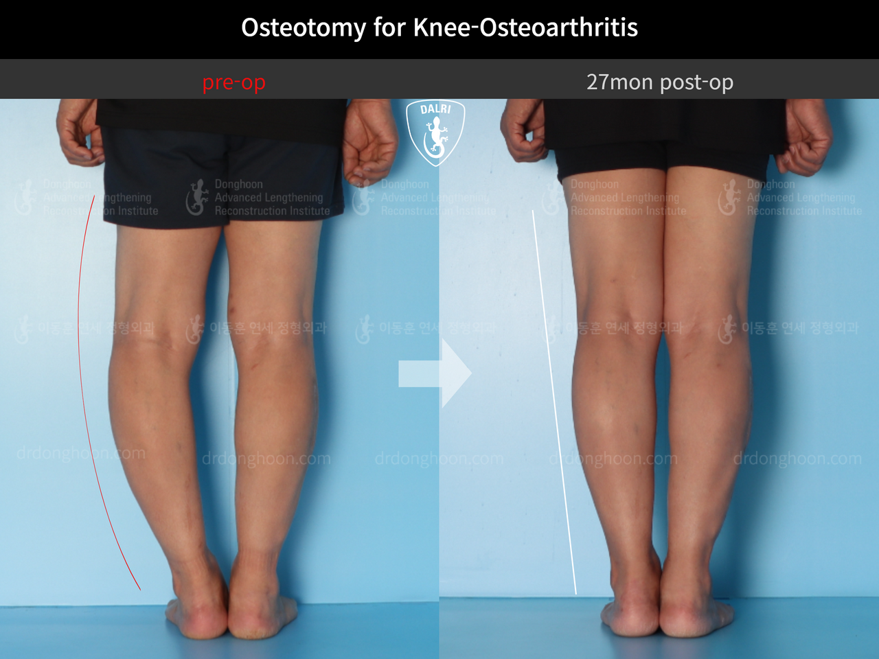 Before and after osteotomy for knee osteoarthritis, case 12535590, image 6, Dr. Donghoon institute (DALRI)
