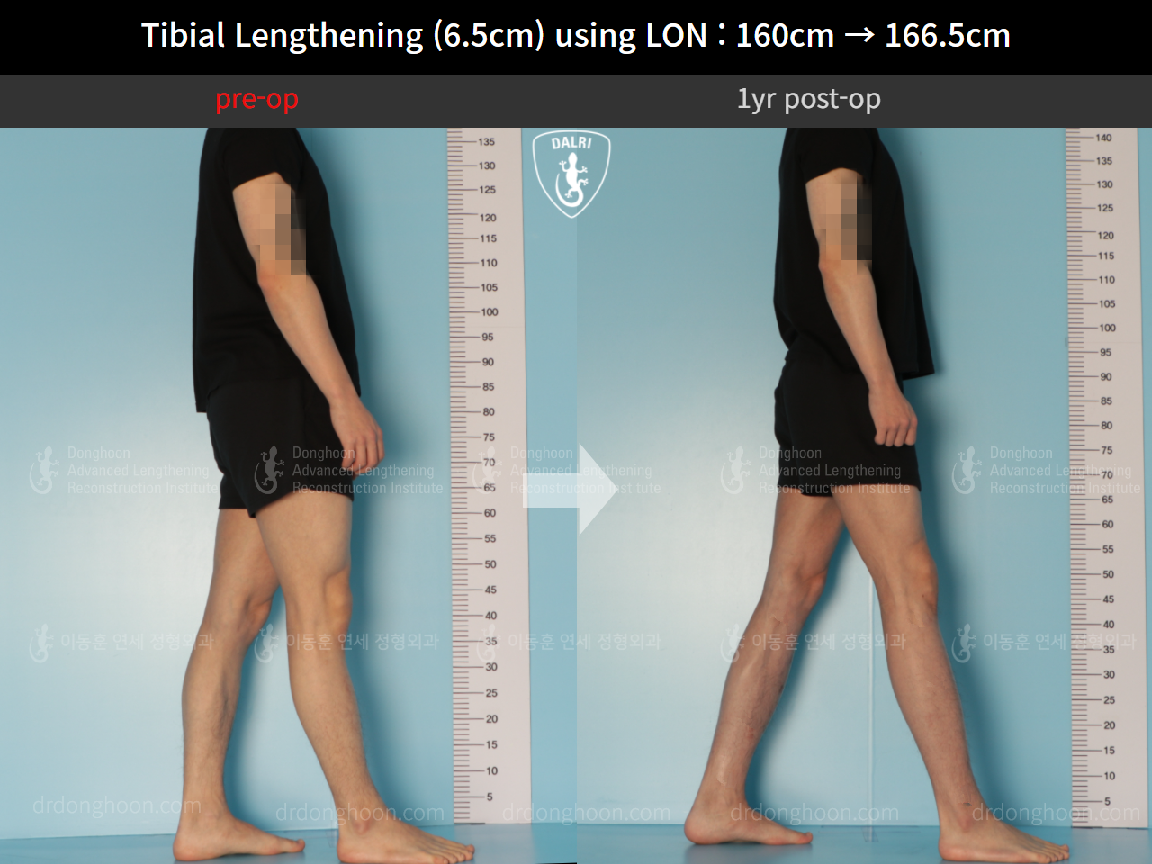 Before and after cll lon, case 10293105, image 4, Dr. Donghoon institute (DALRI)
