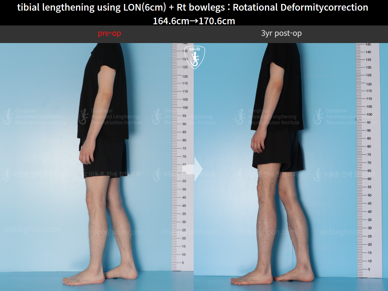 Before and after cll + deformity correction, case 15347322, image 3, Dr. Donghoon institute (DALRI)