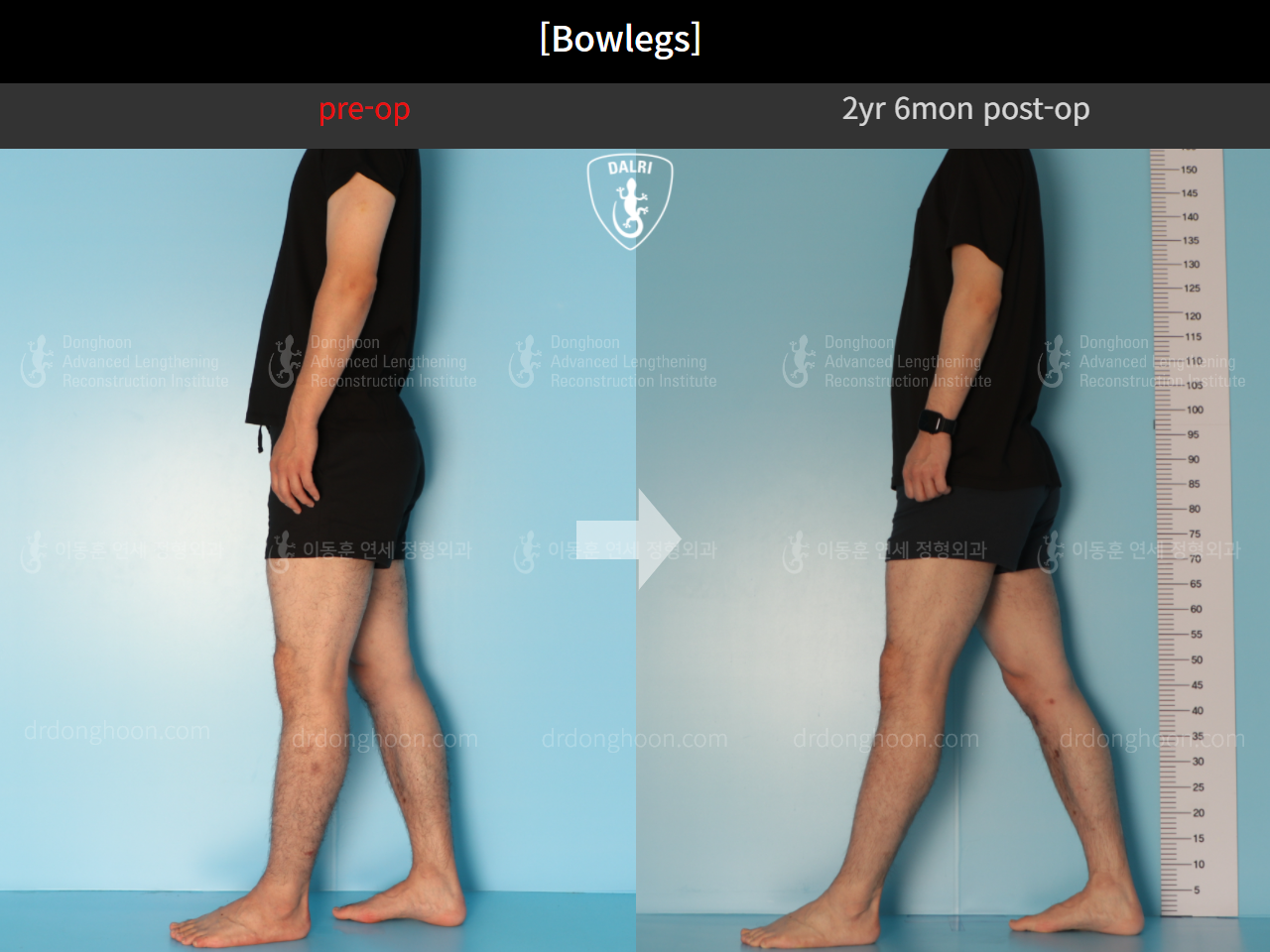 Before and after adult bowlegs, case 11037119, image 6, Dr. Donghoon institute (DALRI)