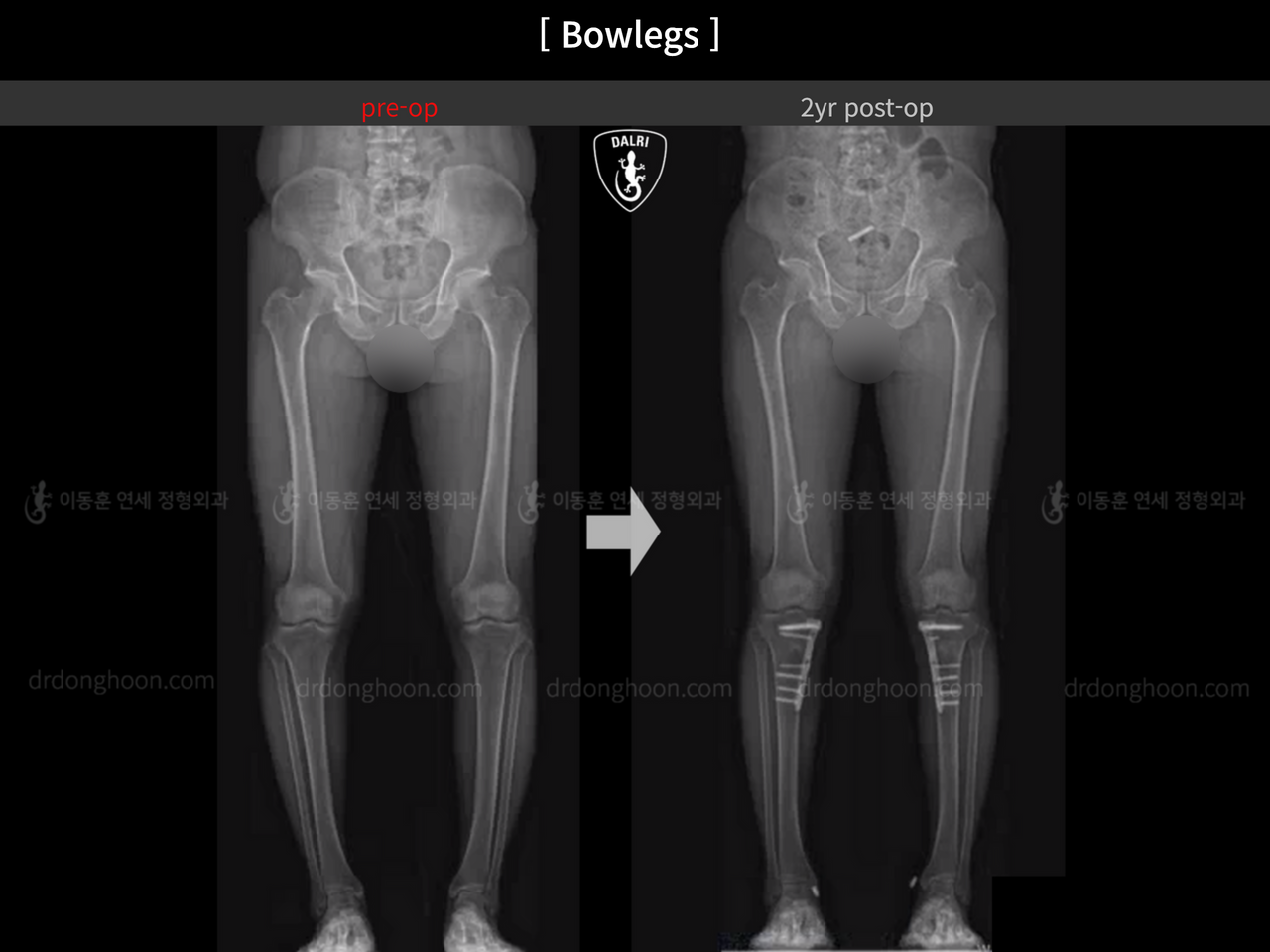 Before and after adult bowlegs, case 14445187, image 7, Dr. Donghoon institute (DALRI)