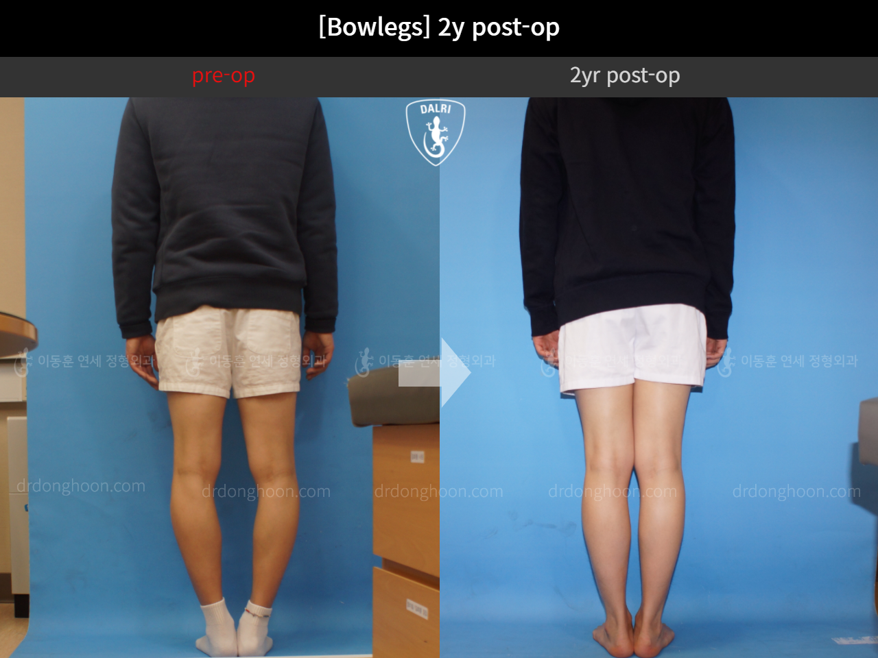 Before and after adult bowlegs, case 4311131, image 2, Dr. Donghoon institute (DALRI)