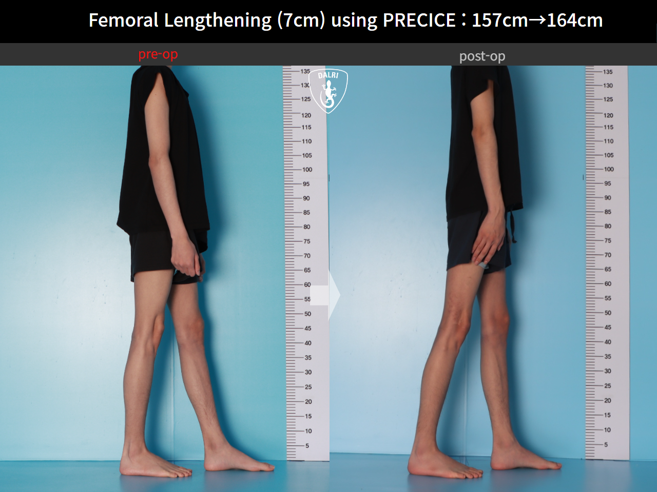 Before and after cll precice, case 31554406, image 6, Dr. Donghoon institute (DALRI)