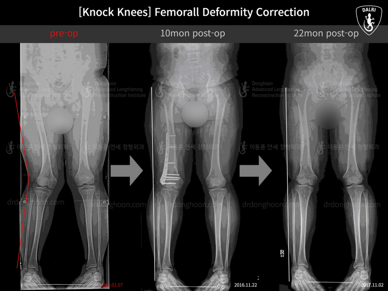 Before and after adult knock knees, case 12760284, image 3, Dr. Donghoon institute (DALRI)