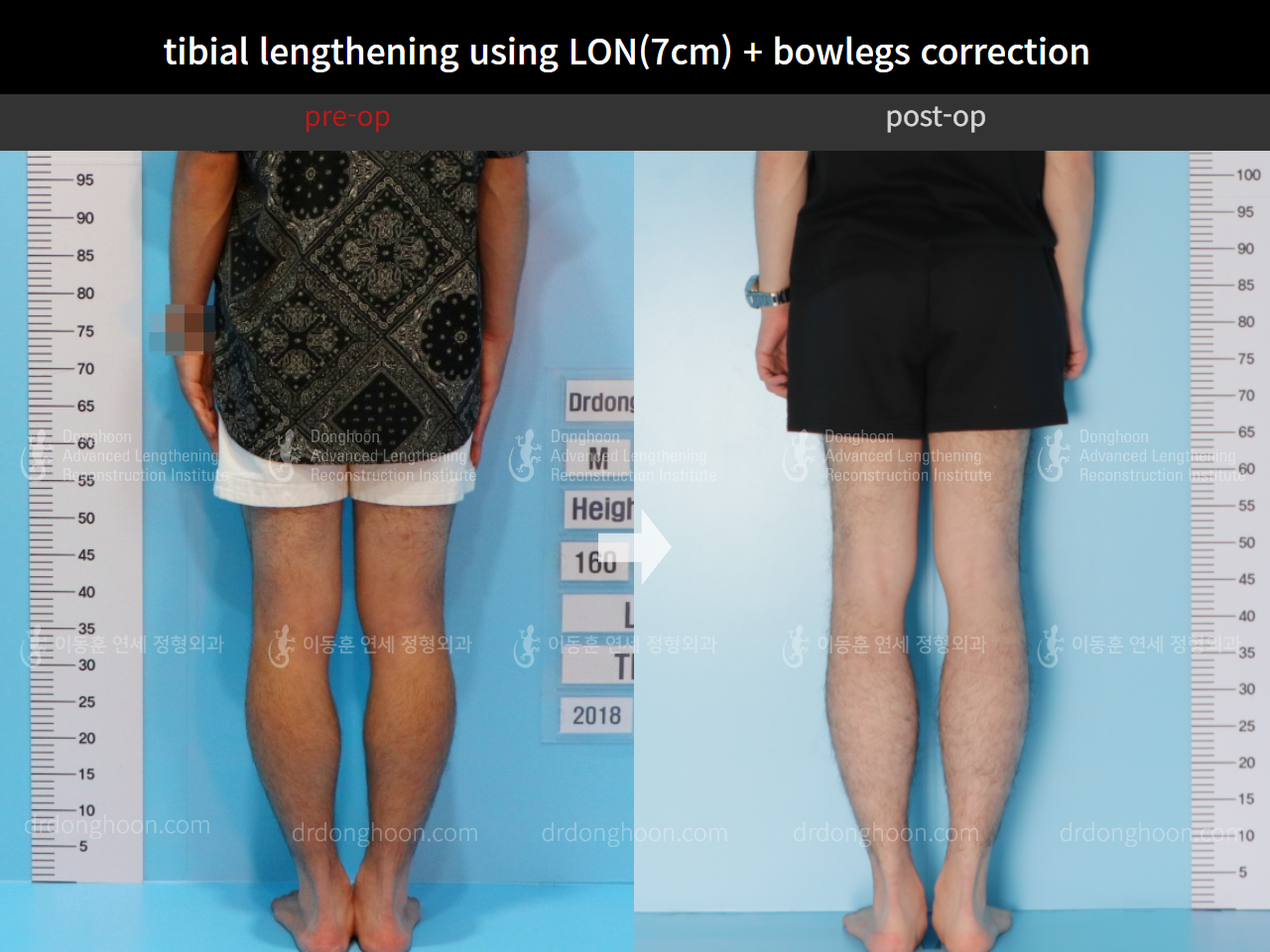 Before and after cll + deformity correction, case 4585644, image 6, Dr. Donghoon institute (DALRI)
