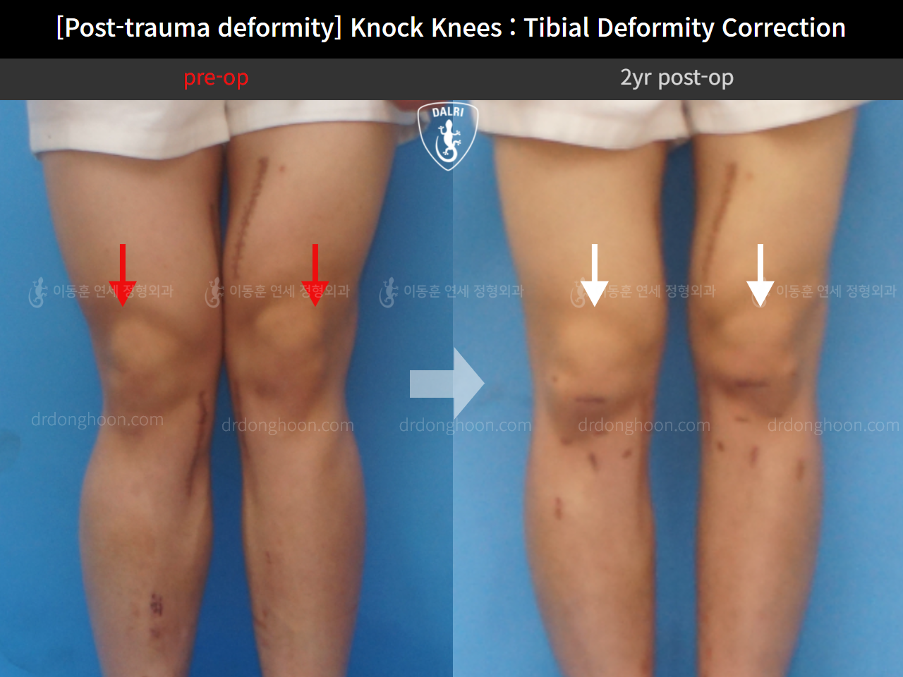 Before and after post-trauma deformity, case 9758216, image 5, Dr. Donghoon institute (DALRI)