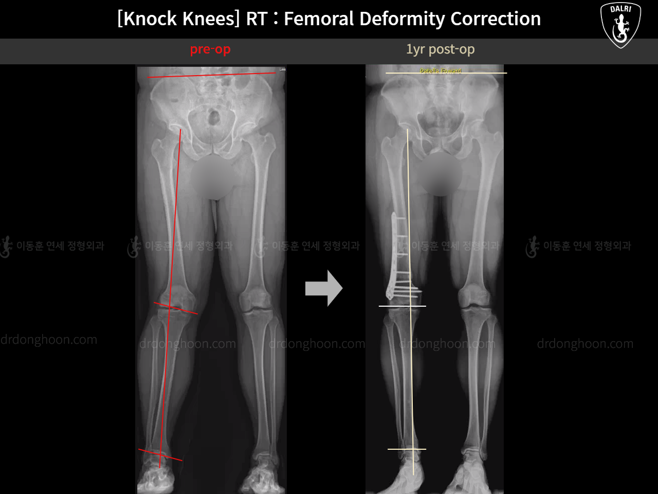 Before and after adult knock knees, case 15950751, image 14, Dr. Donghoon institute (DALRI)