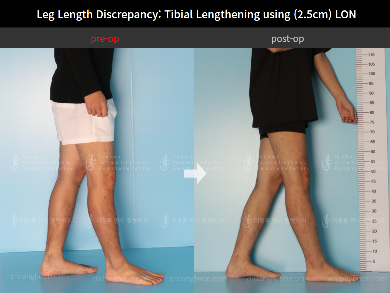 Before and after adult lld, case 8701735, image 4, Dr. Donghoon institute (DALRI)