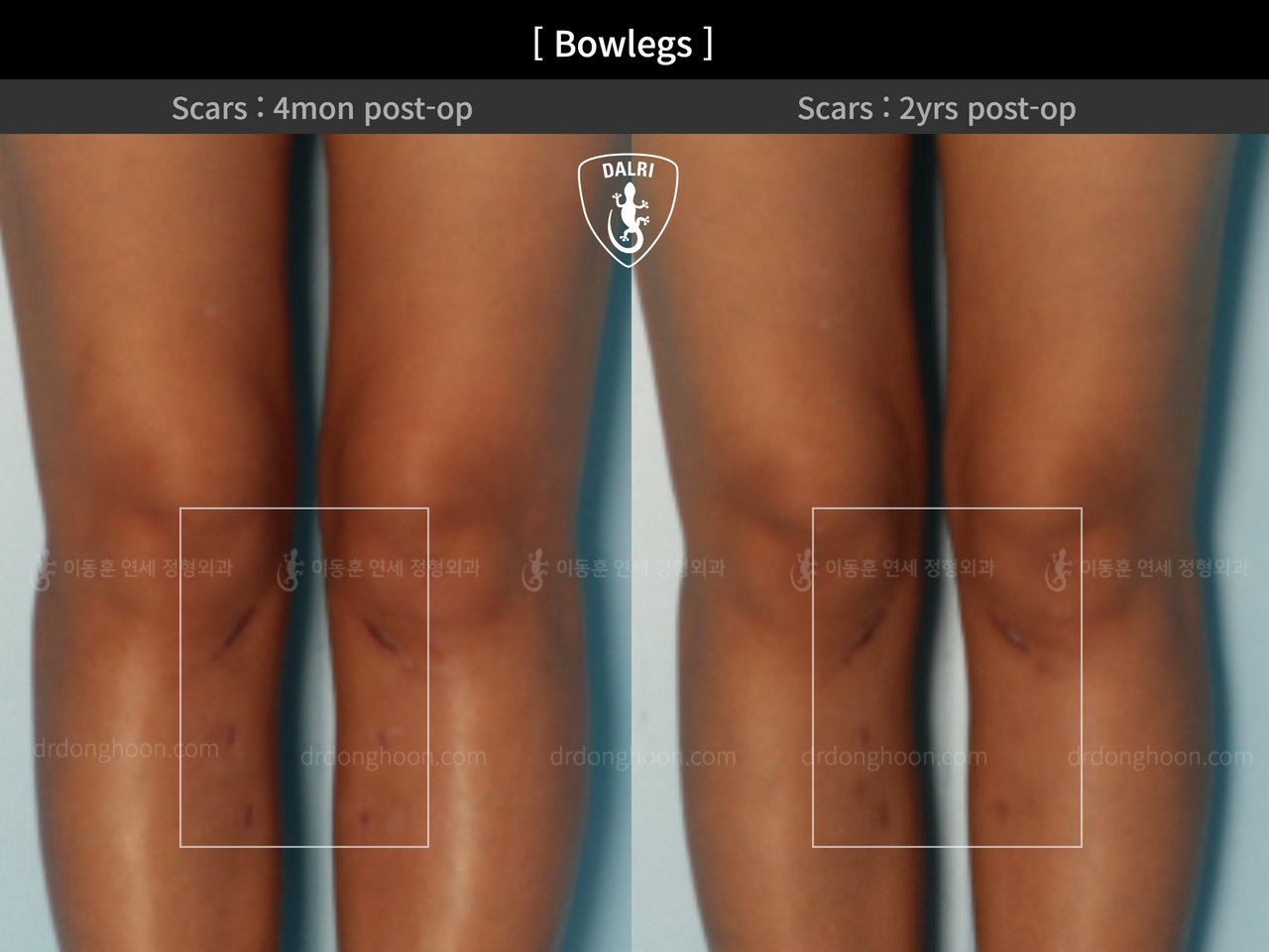 Before and after adult bowlegs, case 12060396, image 7, Dr. Donghoon institute (DALRI)