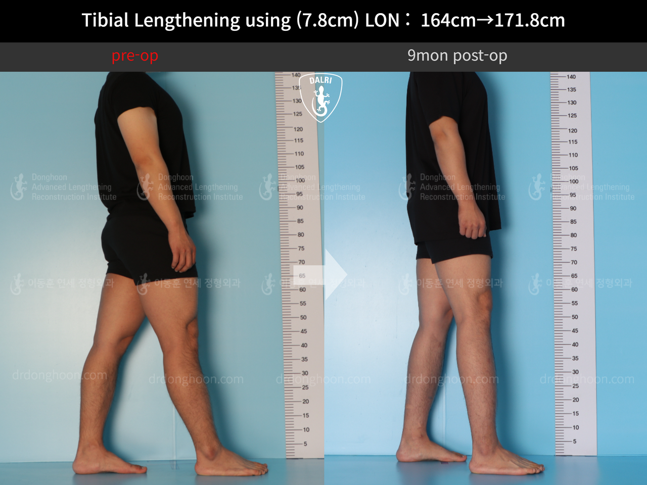 Before and after cll lon, case 12652002, image 3, Dr. Donghoon institute (DALRI)