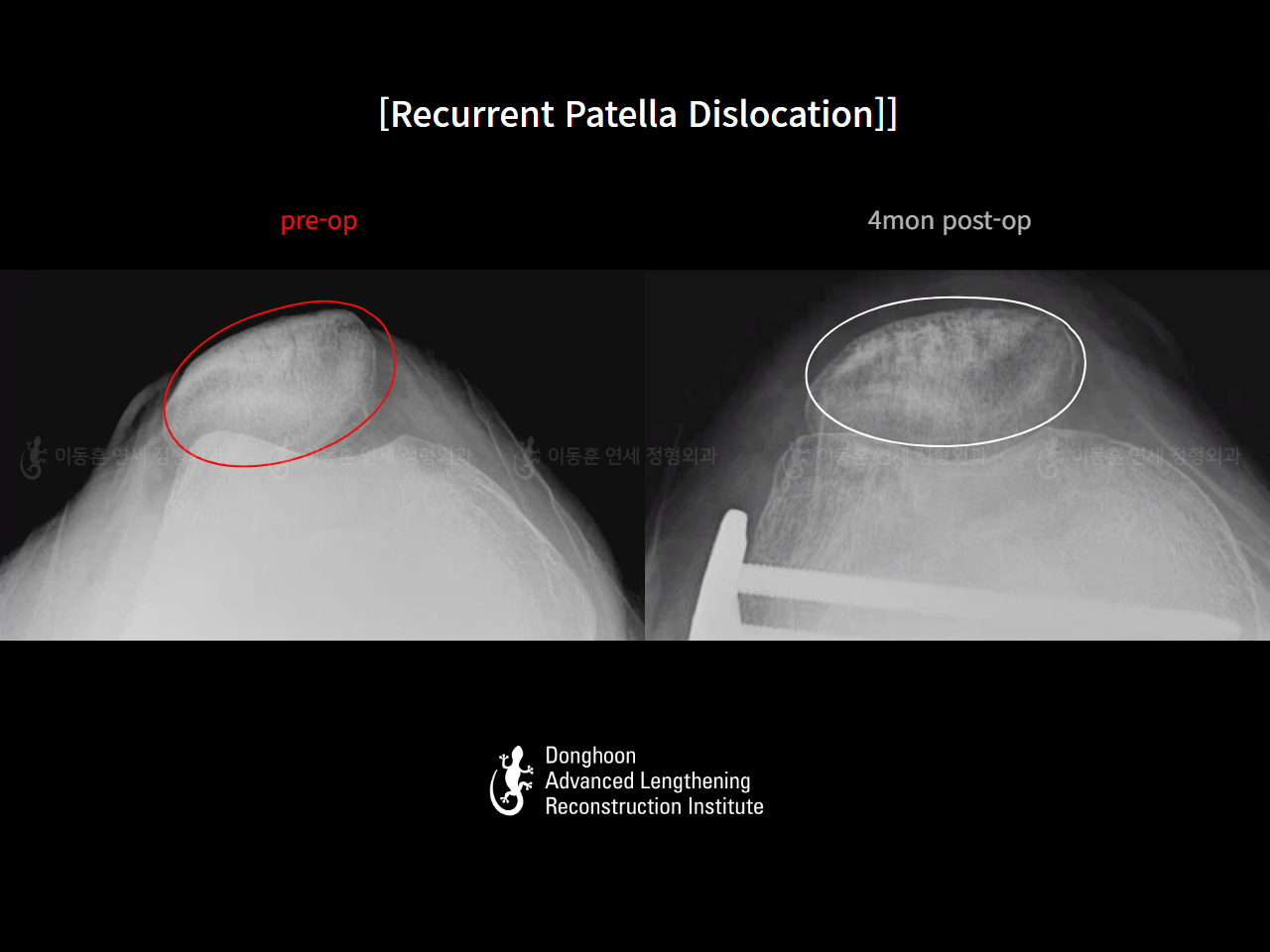Before and after complex deformity, case 125841720, image 12, Dr. Donghoon institute (DALRI)