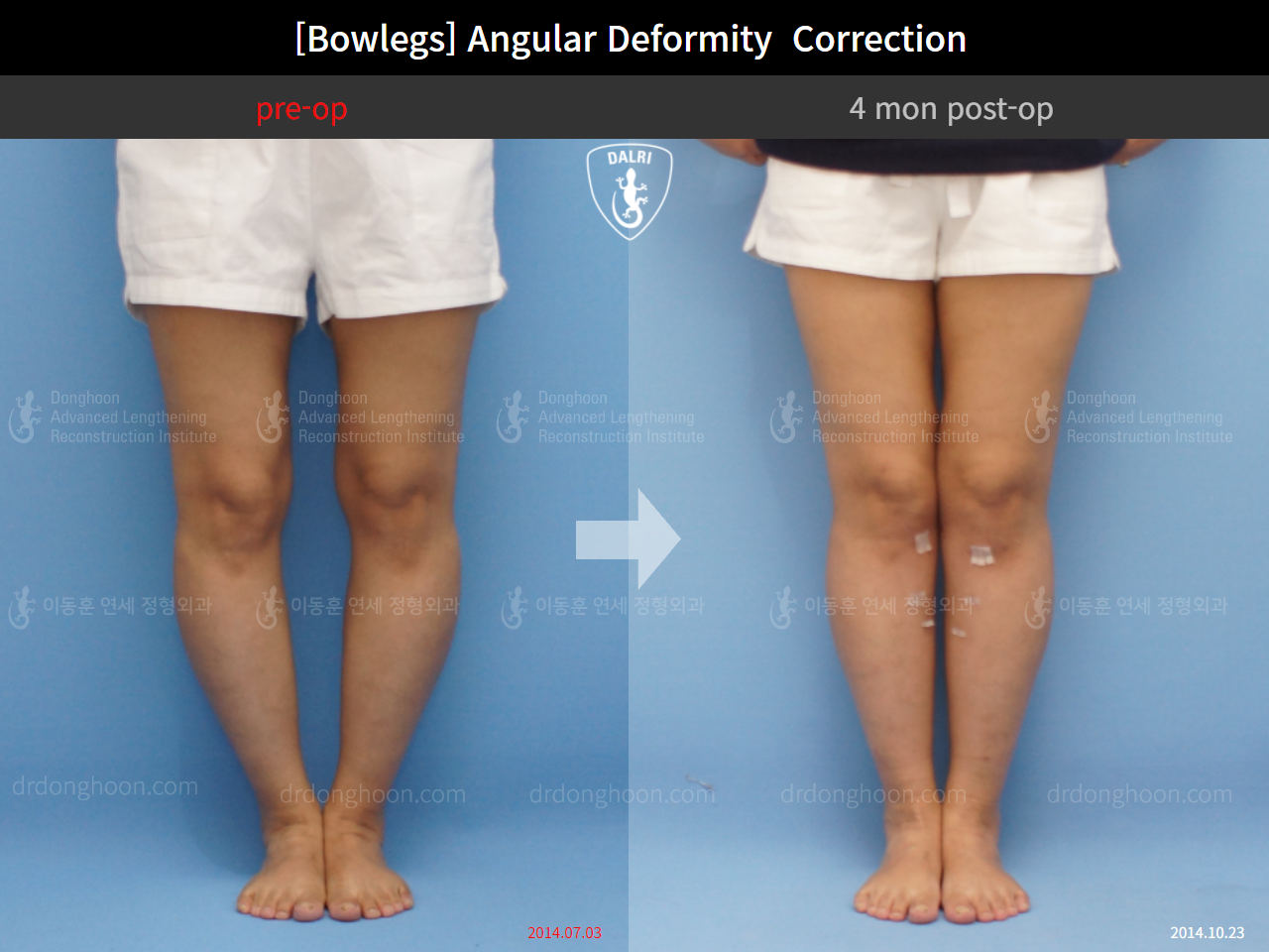 Before and after adult bowlegs, case 9289009, image 5, Dr. Donghoon institute (DALRI)