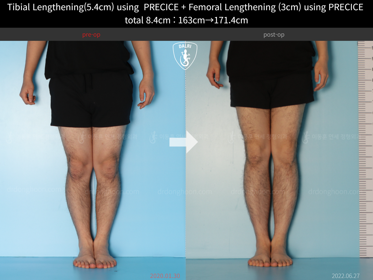 Before and after cll precice, case 12051302, image 7, Dr. Donghoon institute (DALRI)