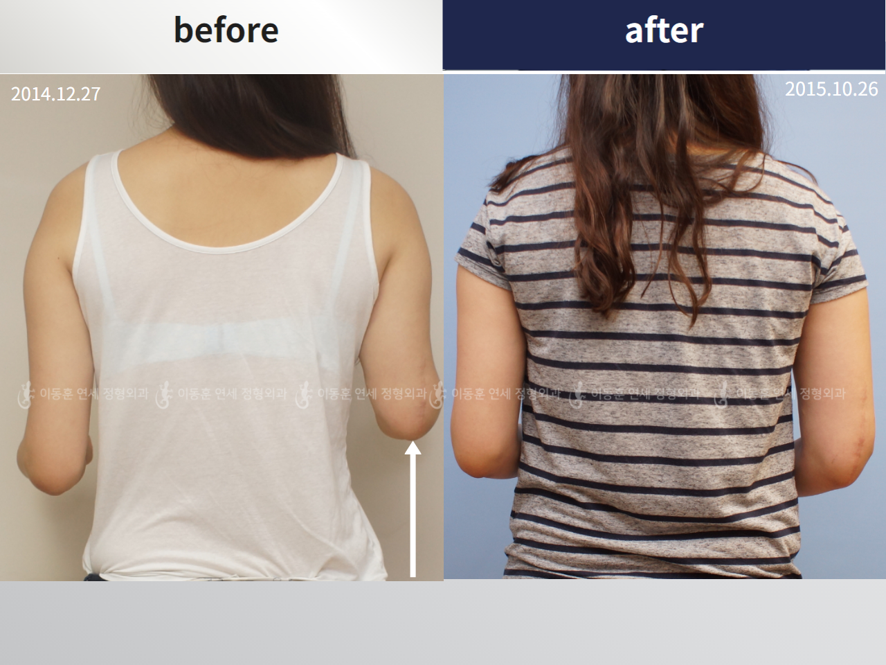 Before and after arm lengthening, case 4249397, image 1, Dr. Donghoon institute (DALRI)