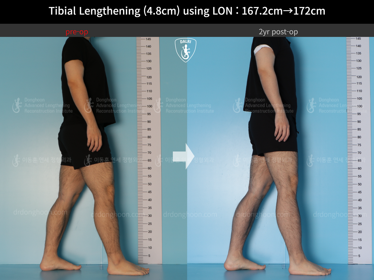 Before and after cll lon, case 14418932, image 3, Dr. Donghoon institute (DALRI)