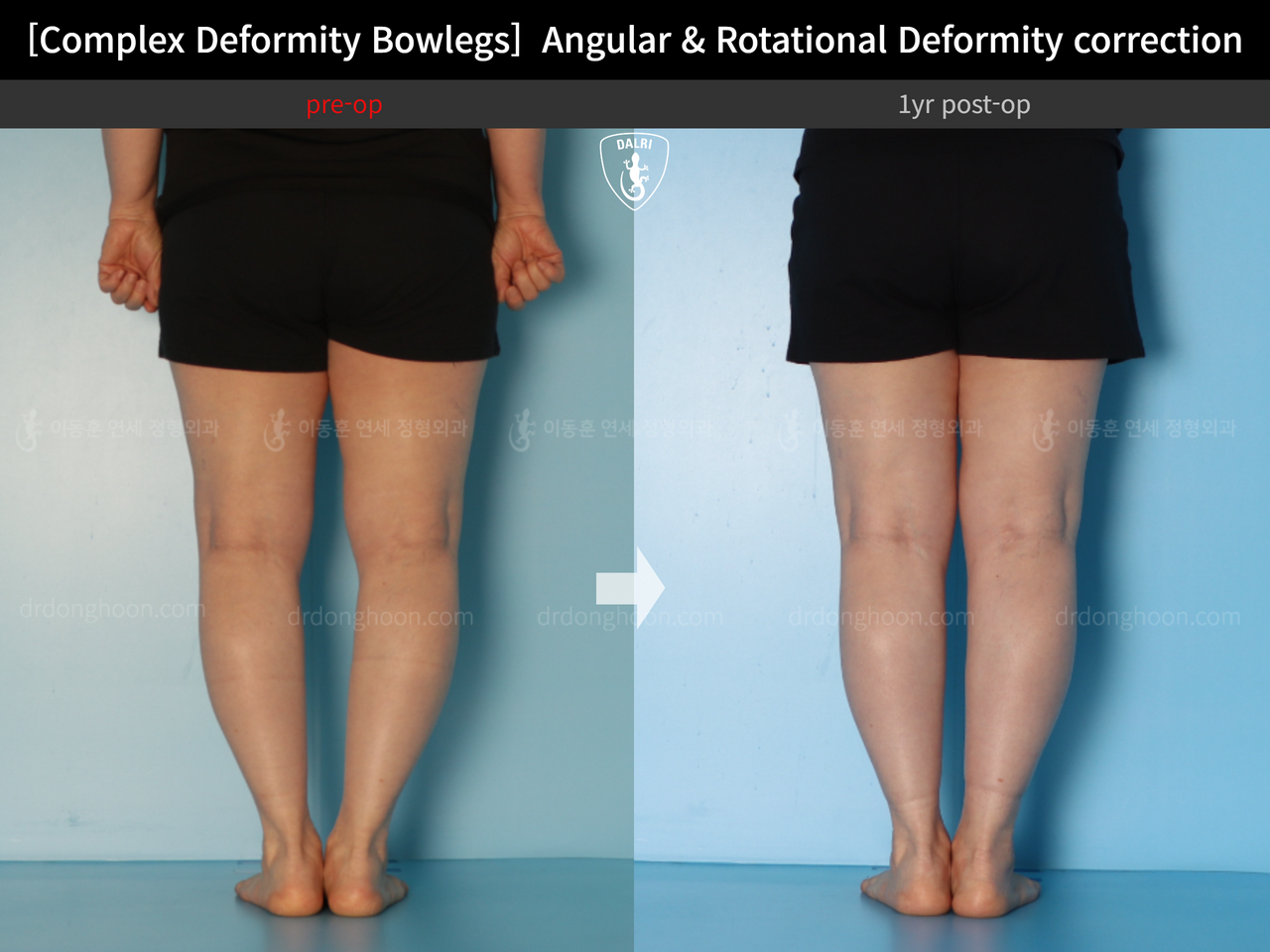 Before and after adult bowlegs, case 14378683, image 6, Dr. Donghoon institute (DALRI)