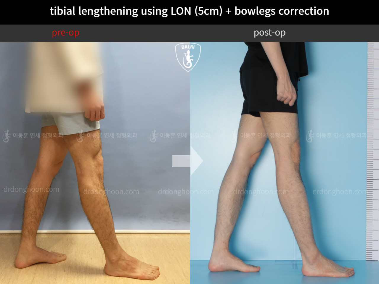 Before and after cll + deformity correction, case 4323130, image 7, Dr. Donghoon institute (DALRI)