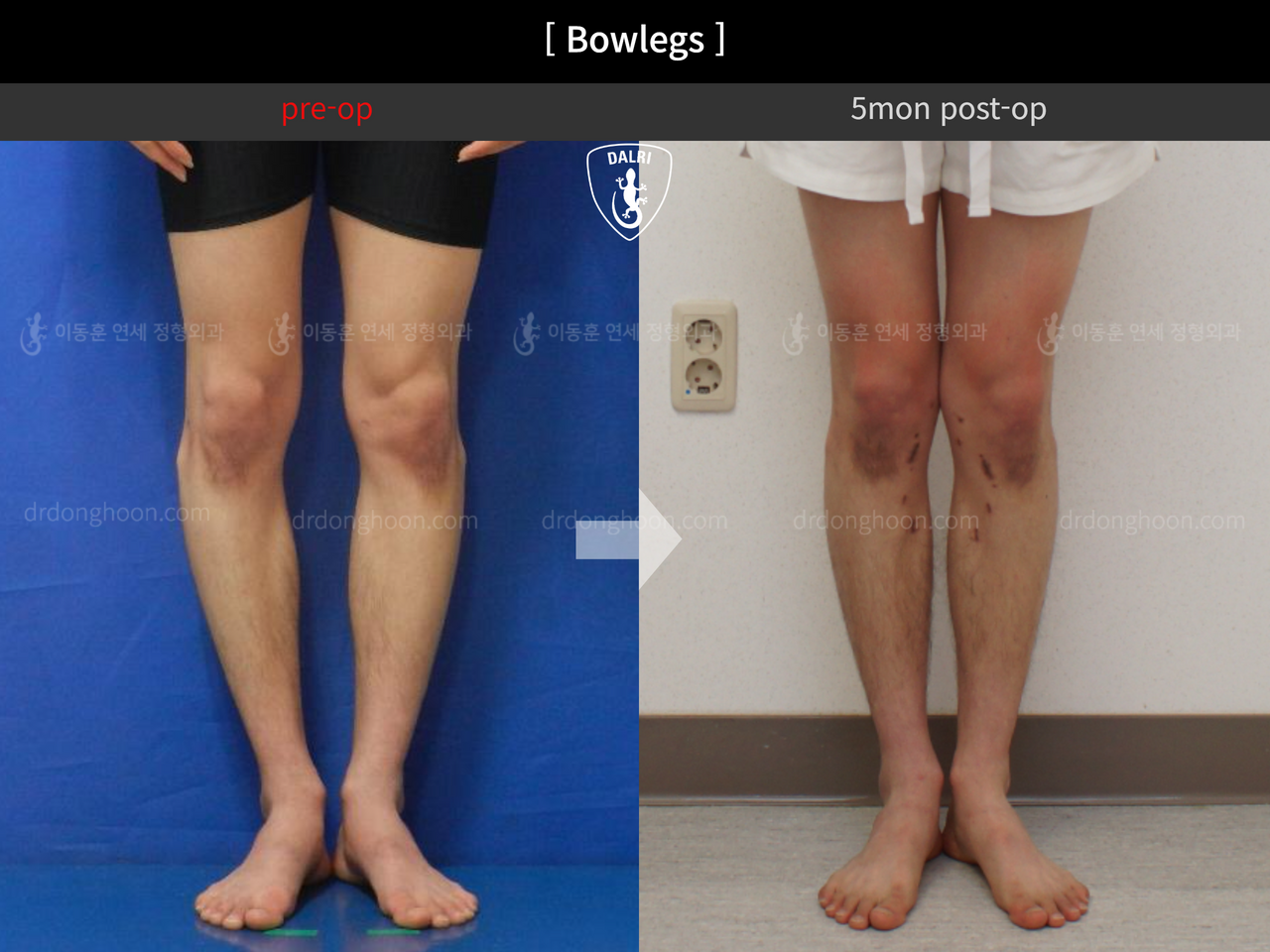 Before and after adult bowlegs, case 12756537, image 5, Dr. Donghoon institute (DALRI)