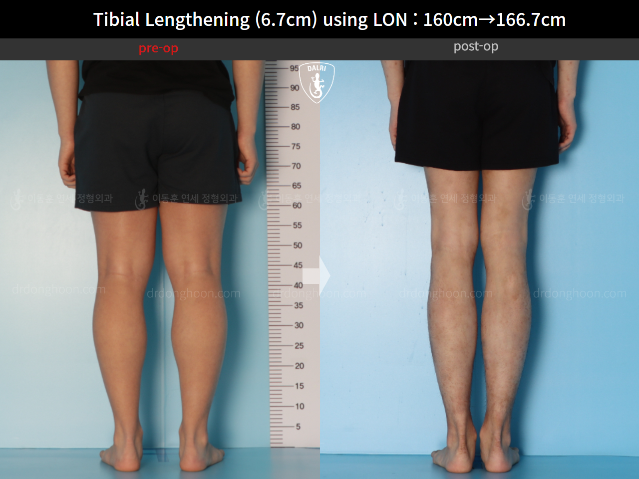 Before and after cll lon, case 15544530, image 6, Dr. Donghoon institute (DALRI)