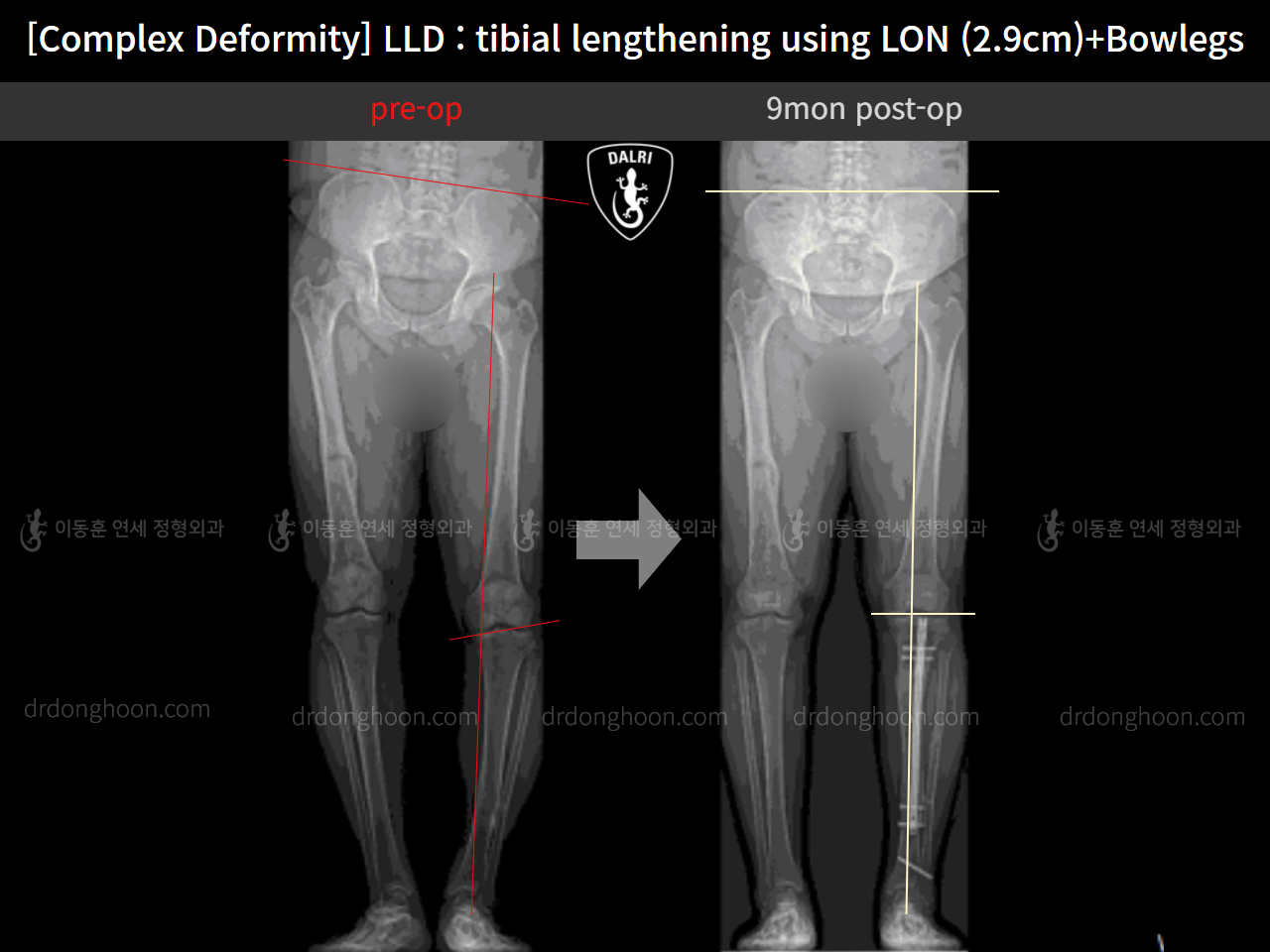 Before and after adult lld, case 11233977, image 9, Dr. Donghoon institute (DALRI)