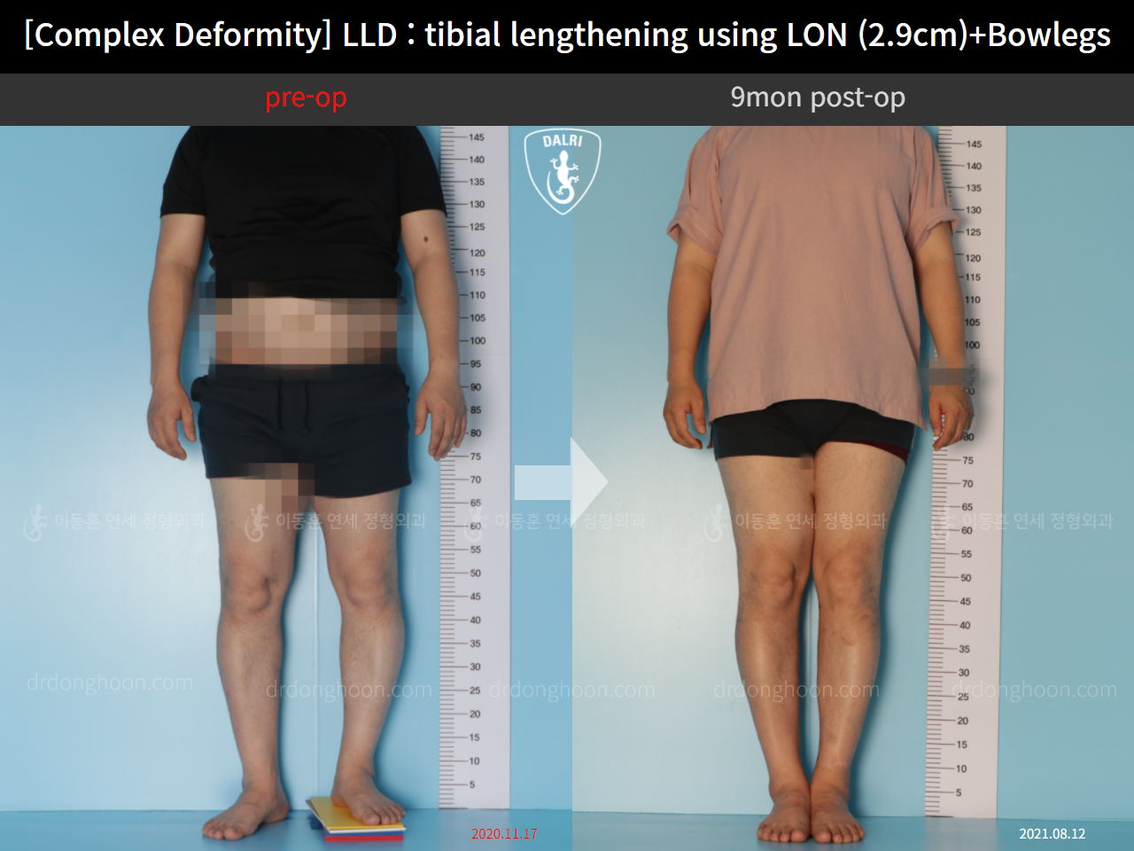 Before and after adult lld, case 11233977, image 1, Dr. Donghoon institute (DALRI)