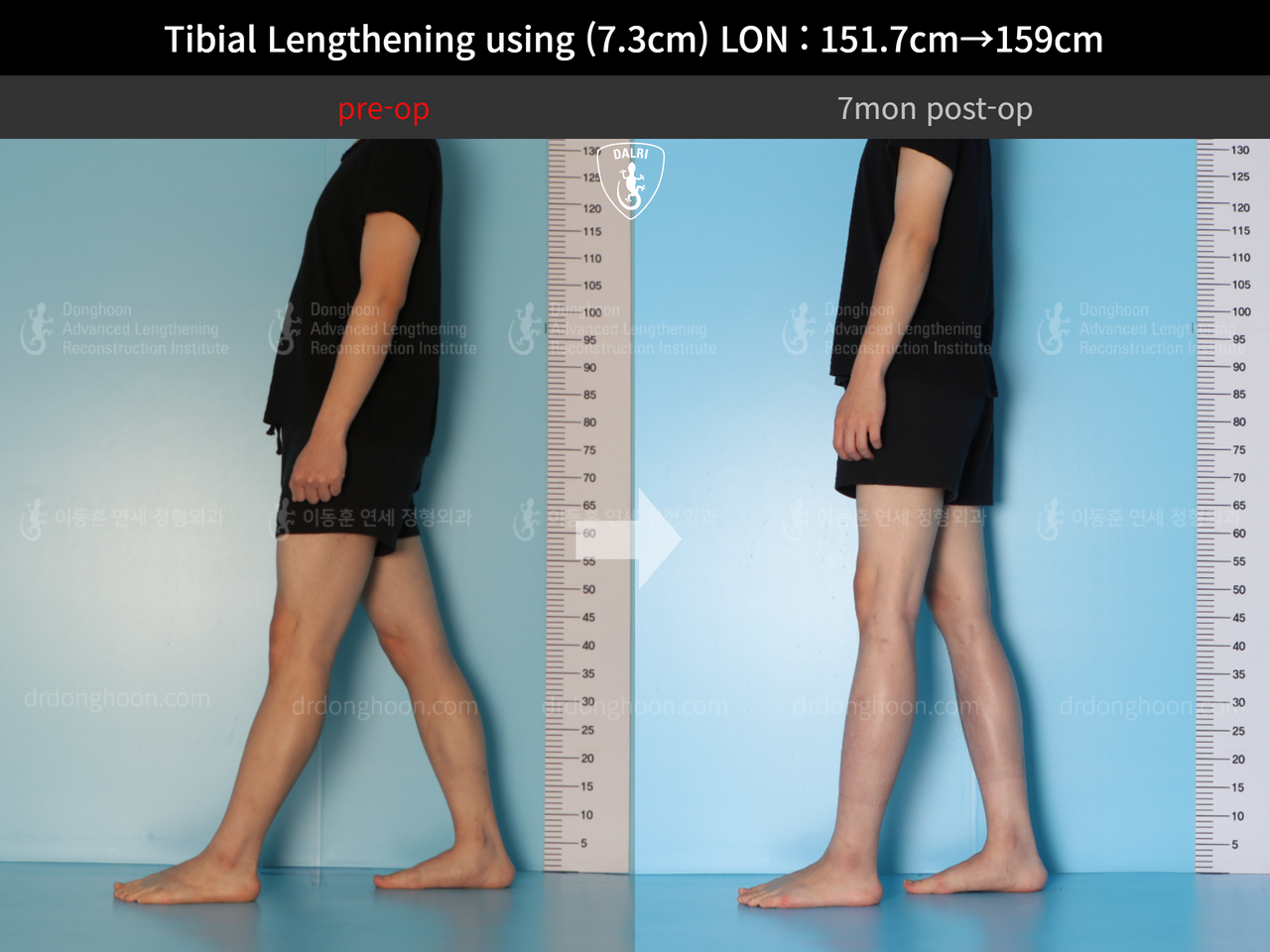 Before and after cll lon, case 13119336, image 4, Dr. Donghoon institute (DALRI)
