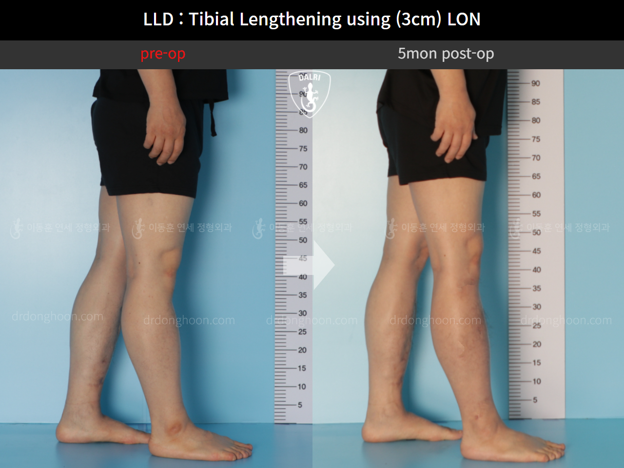 Before and after adult lld, case 11139768, image 6, Dr. Donghoon institute (DALRI)