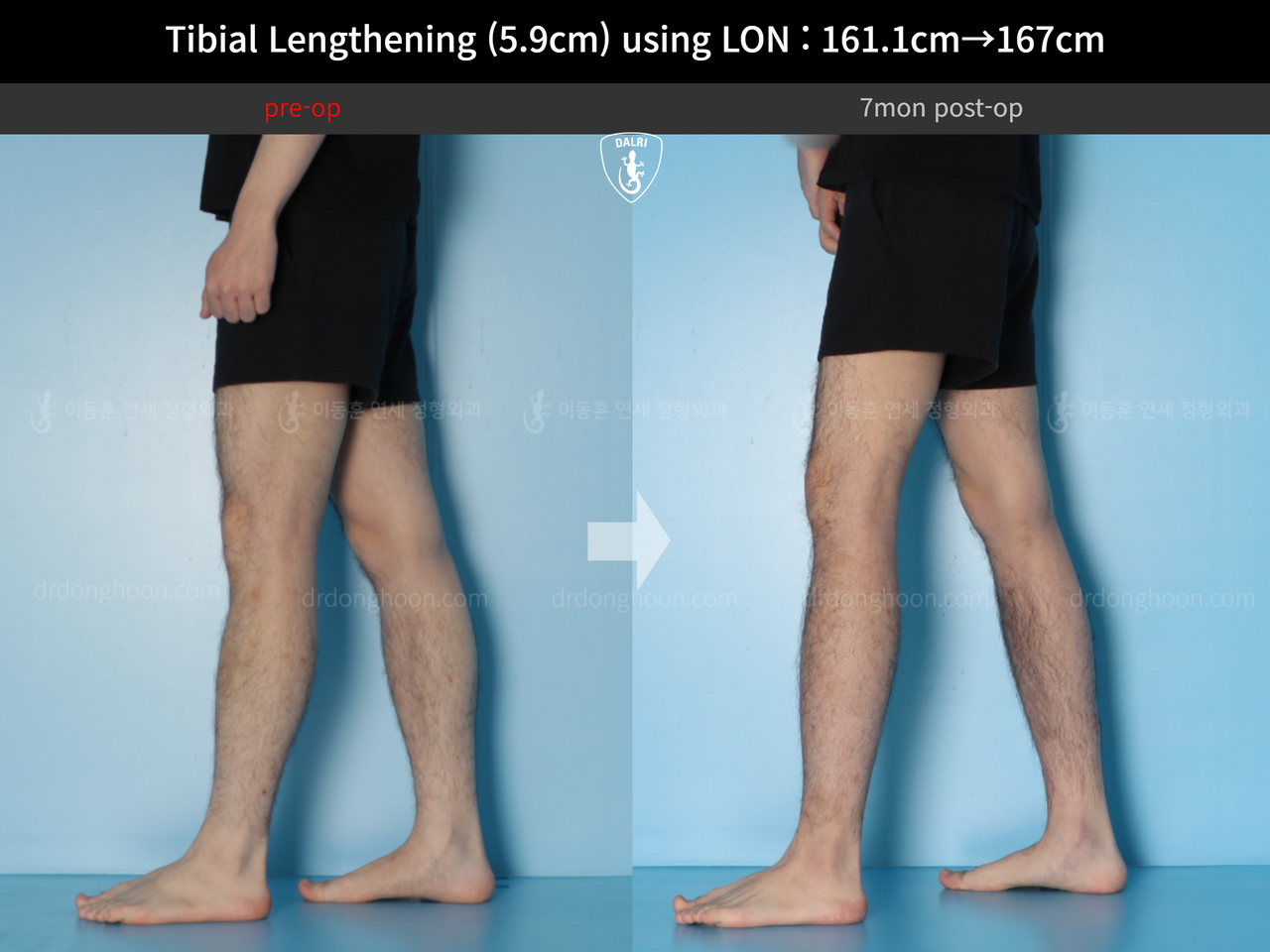 Before and after cll lon, case 14064750, image 10, Dr. Donghoon institute (DALRI)