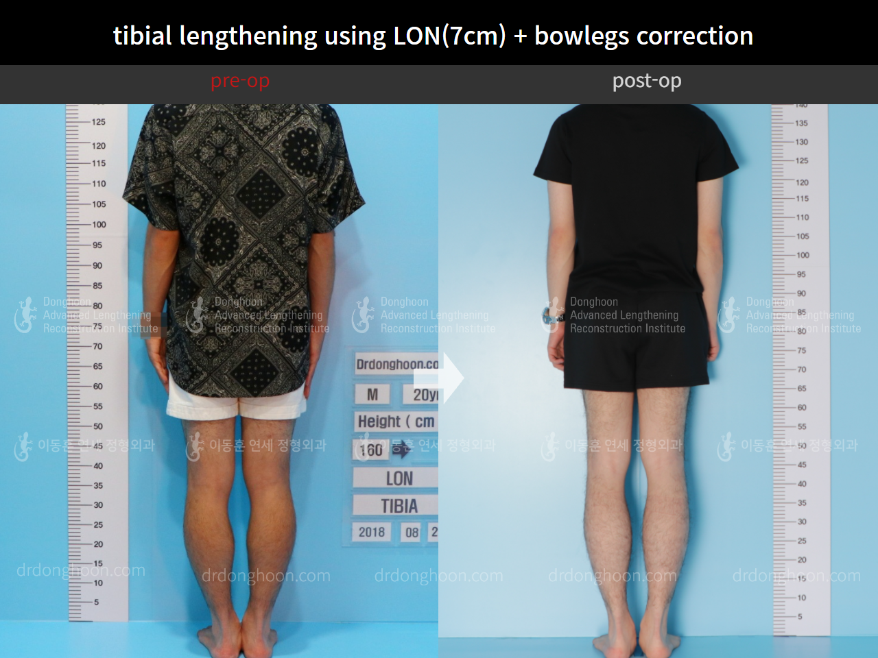 Before and after cll + deformity correction, case 4585644, image 2, Dr. Donghoon institute (DALRI)
