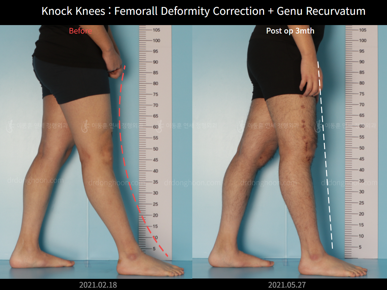 Before and after genu recurvatum, case 7165644, image 2, Dr. Donghoon institute (DALRI)