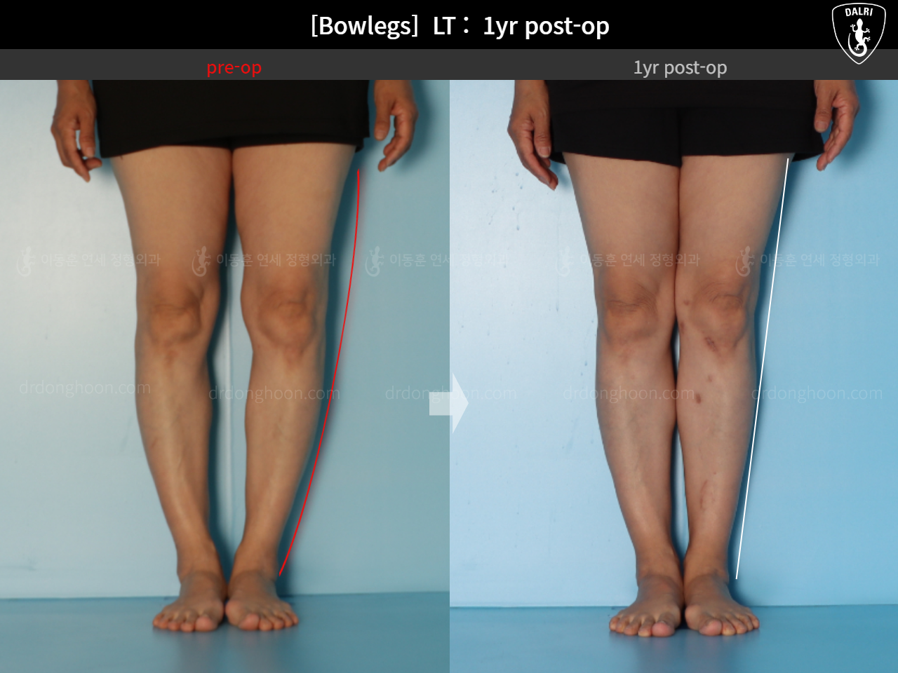 Before and after adult bowlegs, case 15172734, image 8, Dr. Donghoon institute (DALRI)