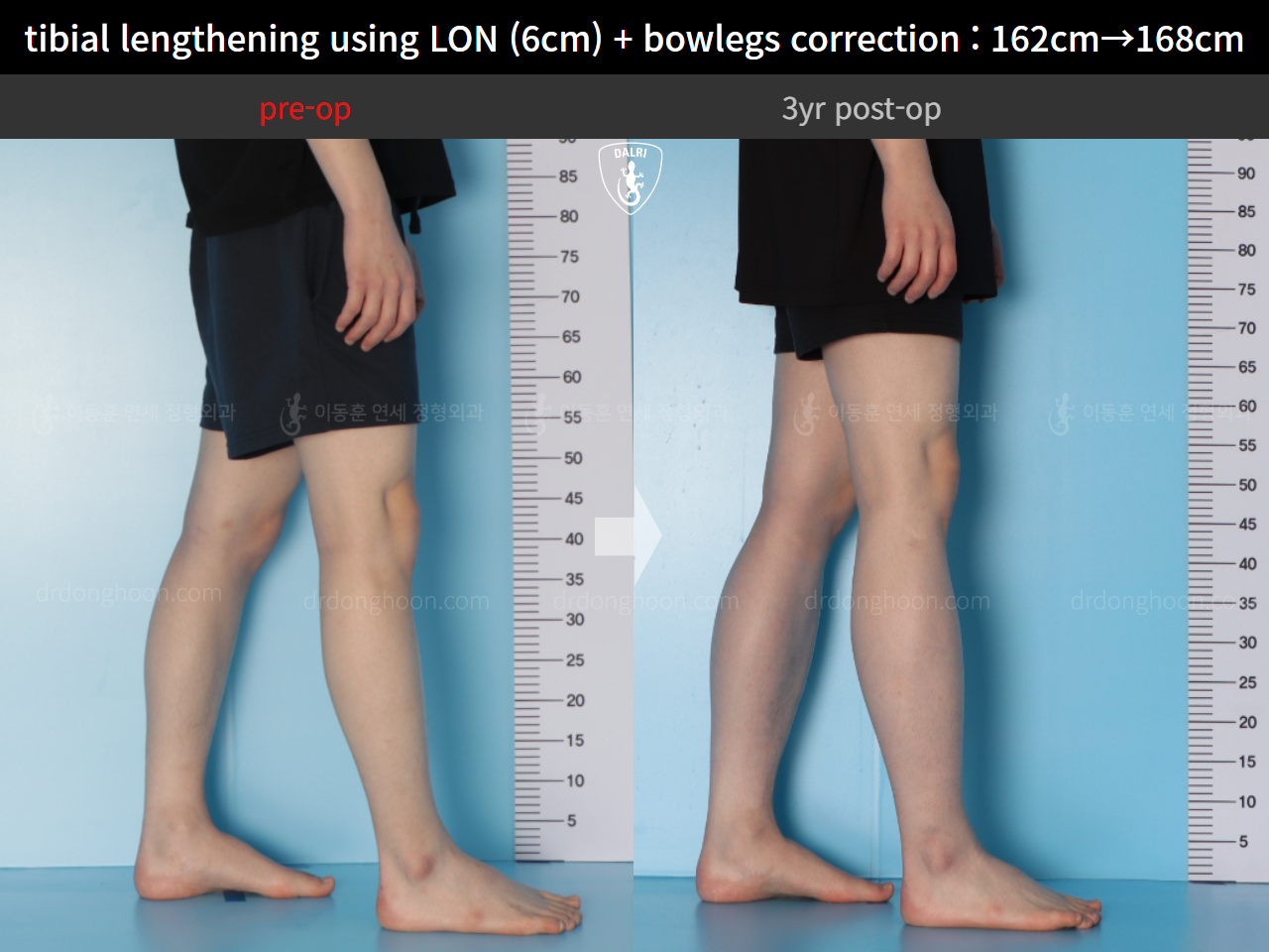 Before and after cll + deformity correction, case 14731799, image 8, Dr. Donghoon institute (DALRI)