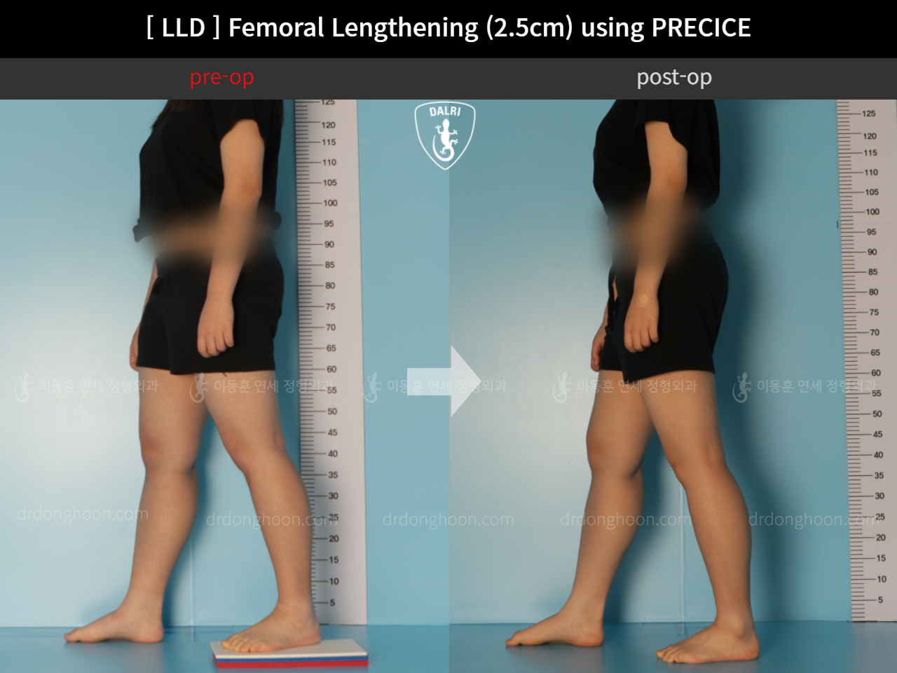 Before and after adult lld, case 11367647, image 3, Dr. Donghoon institute (DALRI)
