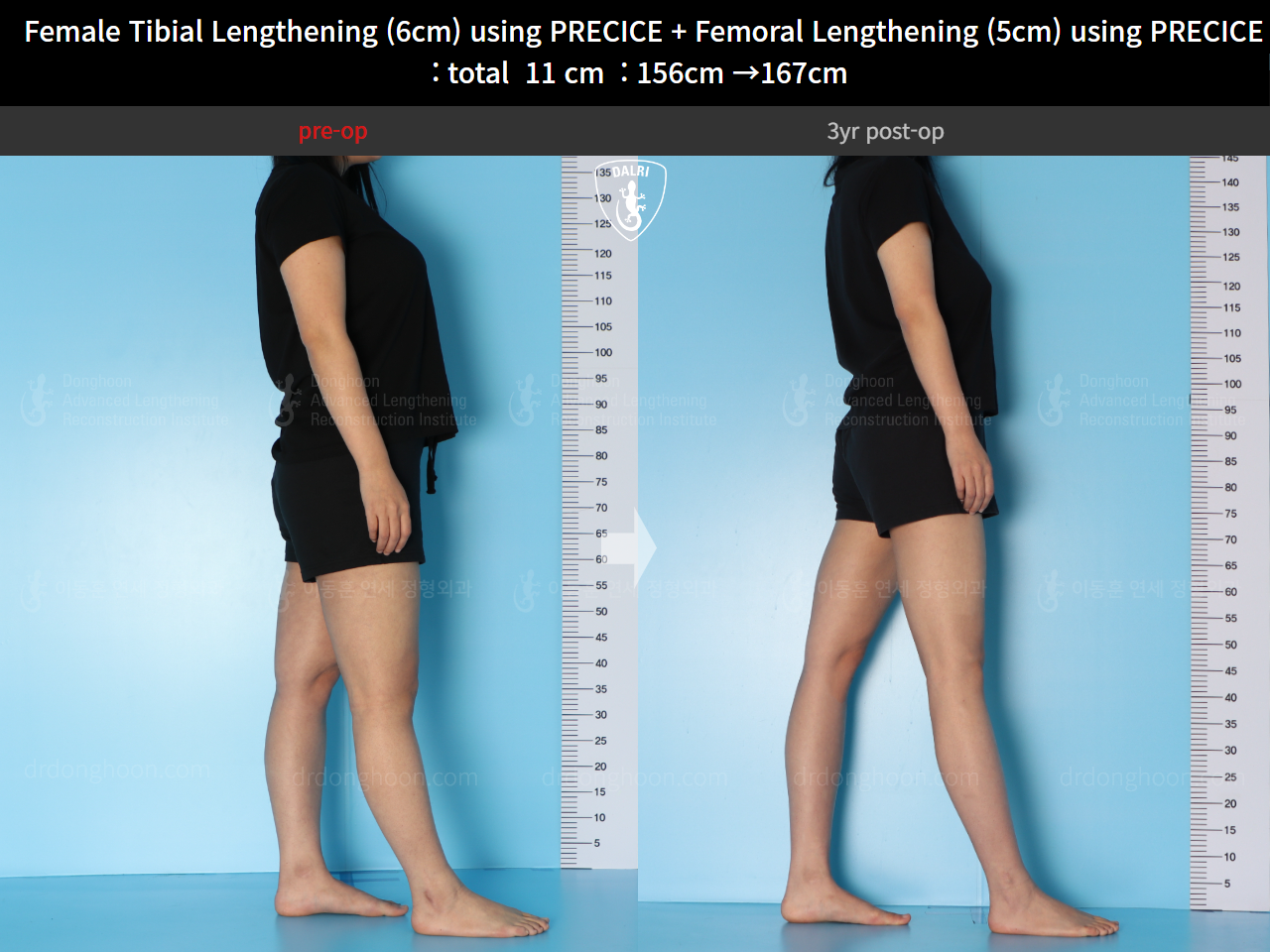Before and after cll precice, case 24986271, image 3, Dr. Donghoon institute (DALRI)
