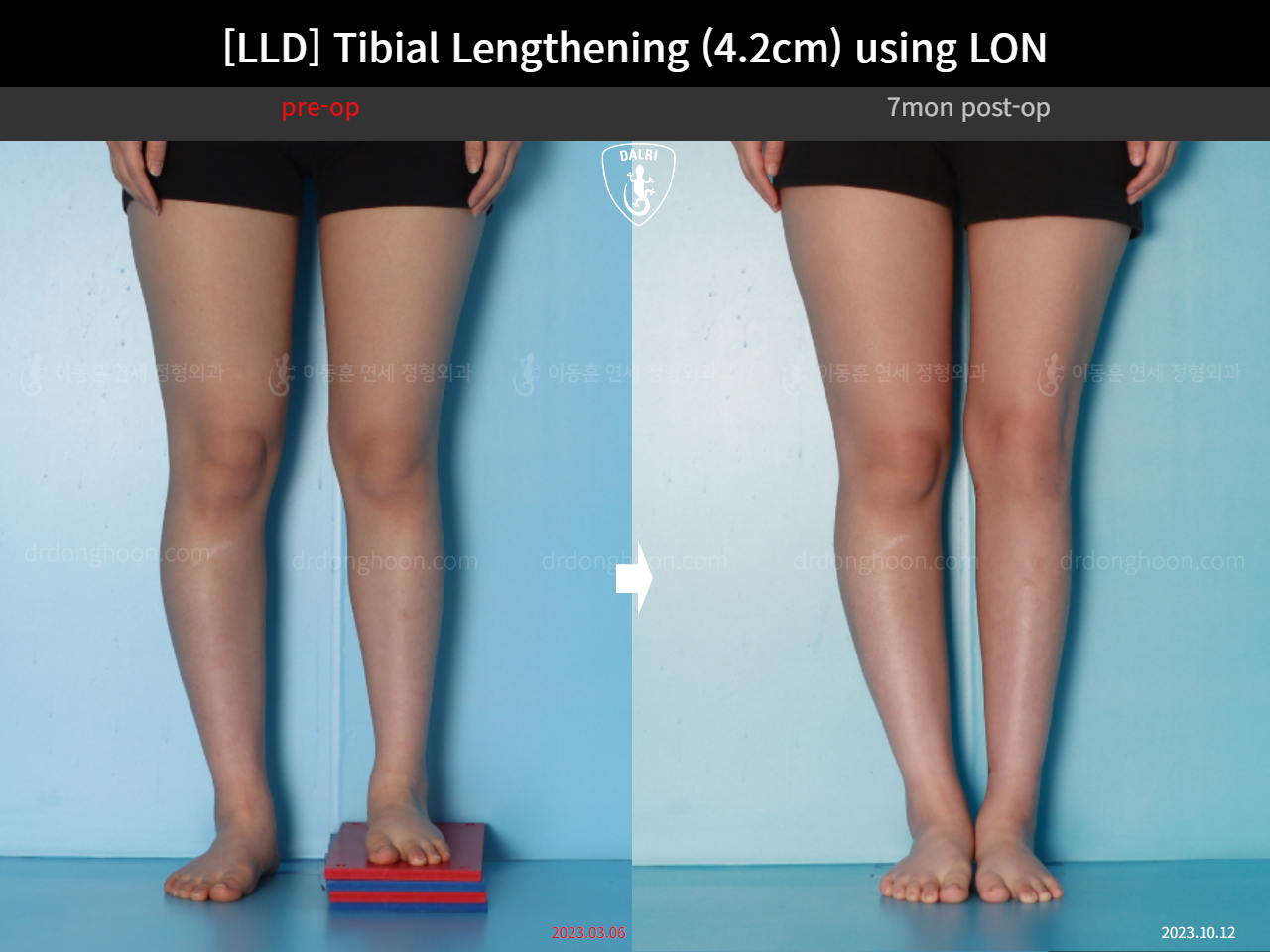 Before and after adult lld, case 16933852, image 6, Dr. Donghoon institute (DALRI)