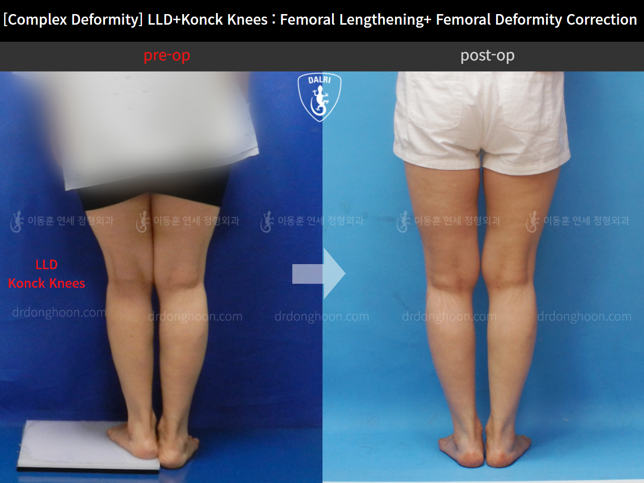 Before and after adult lld, case 11107365, image 4, Dr. Donghoon institute (DALRI)