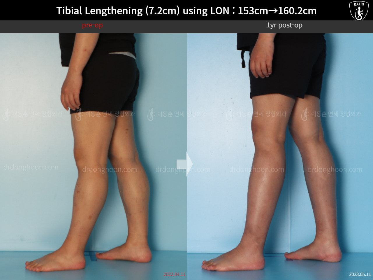 Before and after cll lon, case 15150707, image 7, Dr. Donghoon institute (DALRI)